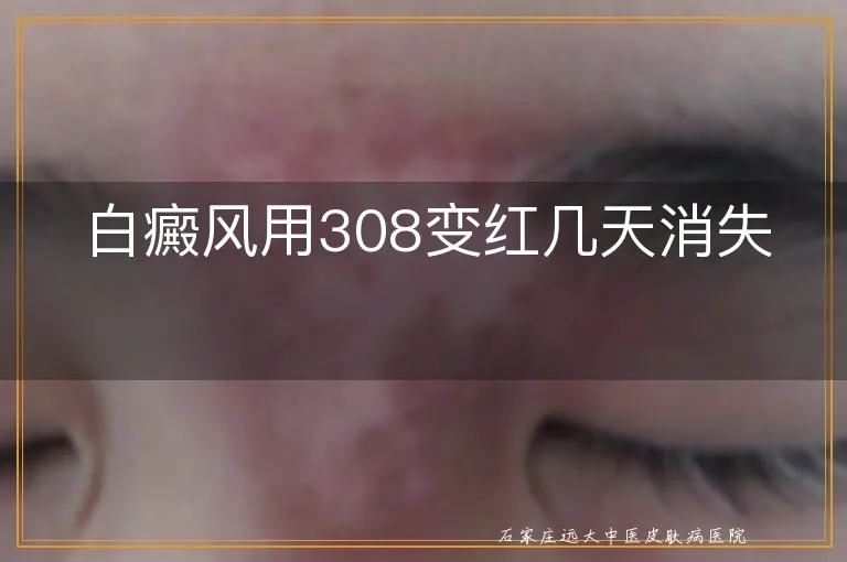 白癜风用308变红几天消失