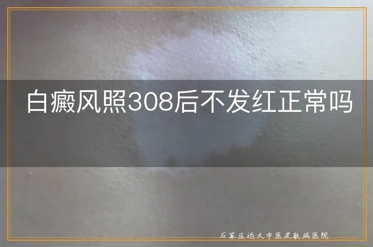 白癜风照308后不发红正常吗