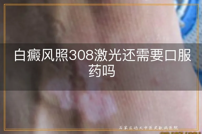 白癜风照308激光还需要口服药吗