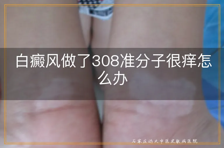 白癜风做了308准分子很痒怎么办