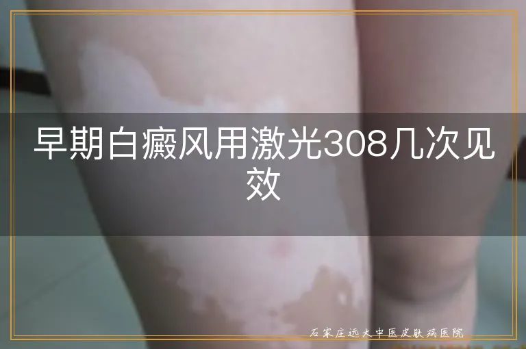 早期白癜风用激光308几次见效