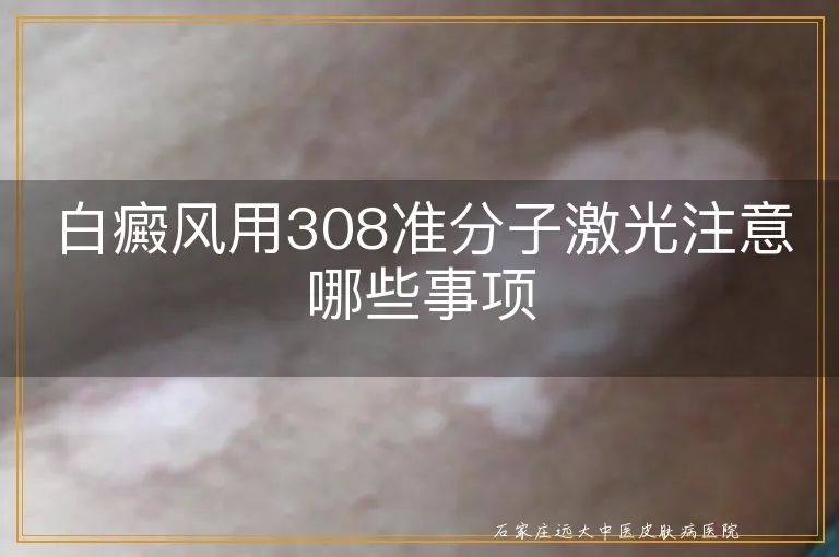 白癜风用308准分子激光注意哪些事项