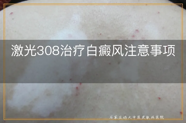 激光308治疗白癜风注意事项