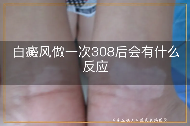 白癜风做一次308后会有什么反应