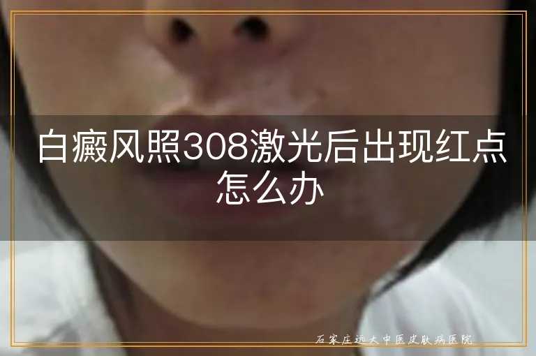 白癜风照308激光后出现红点怎么办