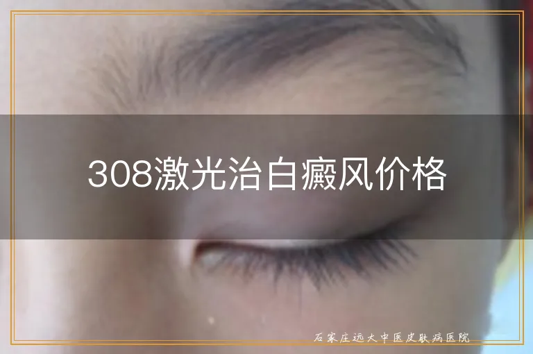 308激光治白癜风价格