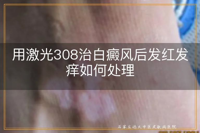 用激光308治白癜风后发红发痒如何处理