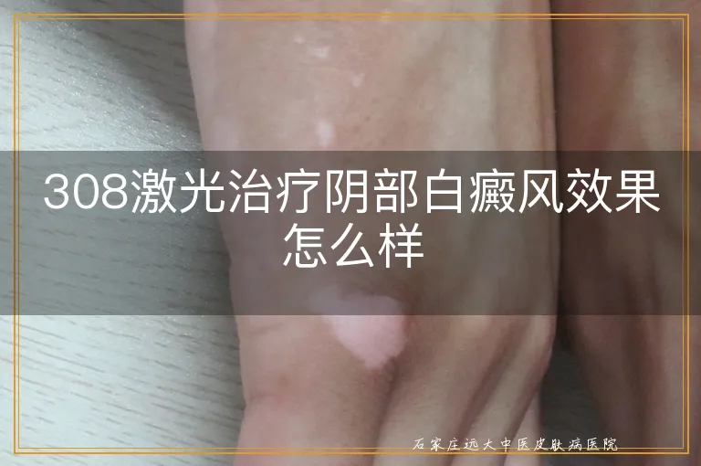 308激光治疗阴部白癜风效果怎么样