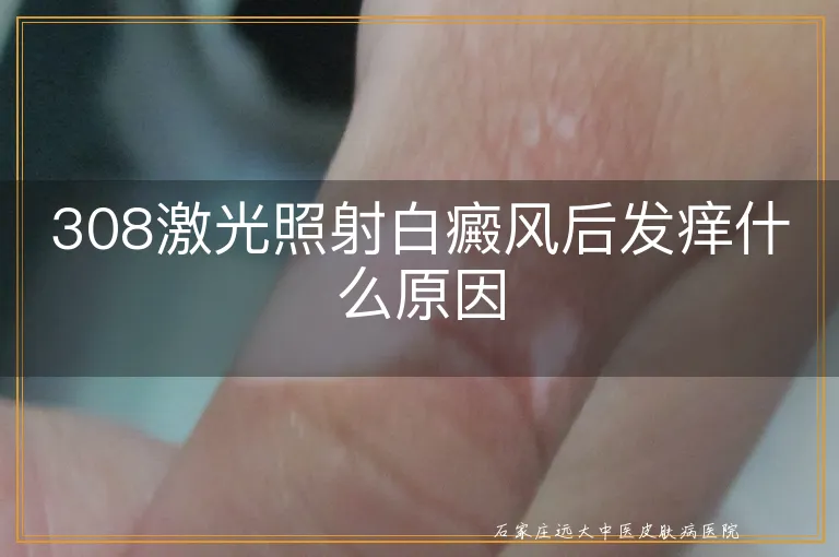 308激光照射白癜风后发痒什么原因