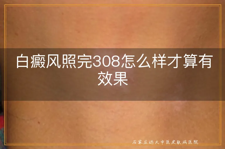 白癜风照完308怎么样才算有效果