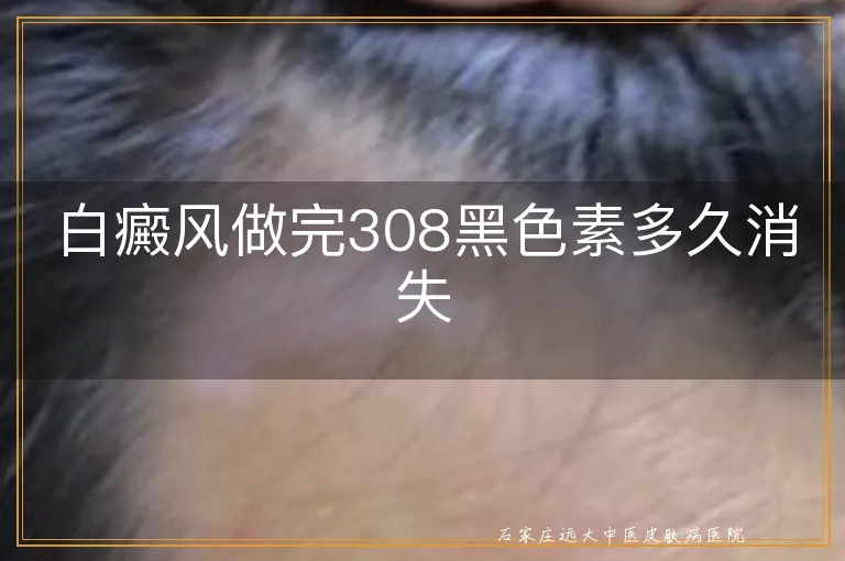 白癜风做完308黑色素多久消失