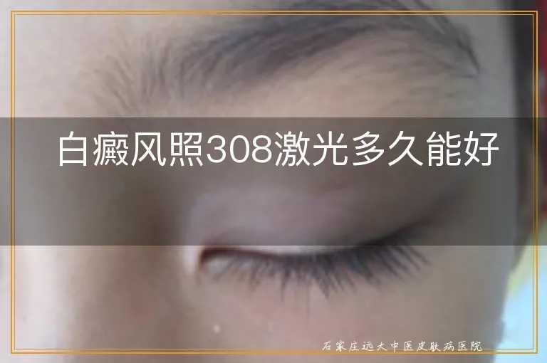 白癜风照308激光多久能好