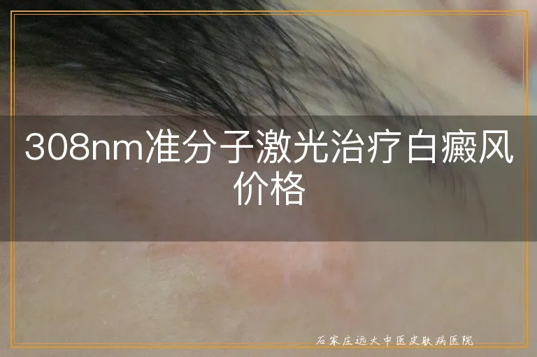 308nm准分子激光治疗白癜风价格