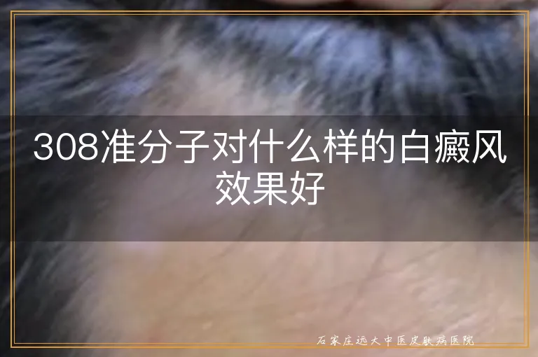 308准分子对什么样的白癜风效果好