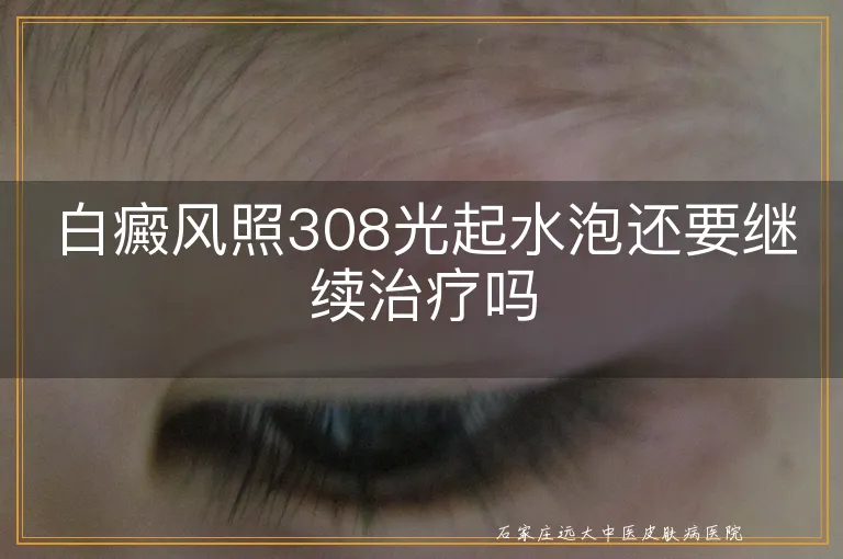 白癜风照308光起水泡还要继续治疗吗