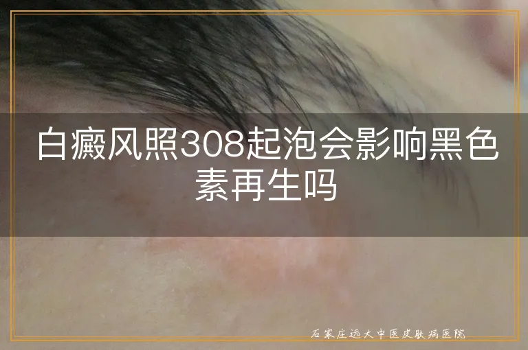 白癜风照308起泡会影响黑色素再生吗