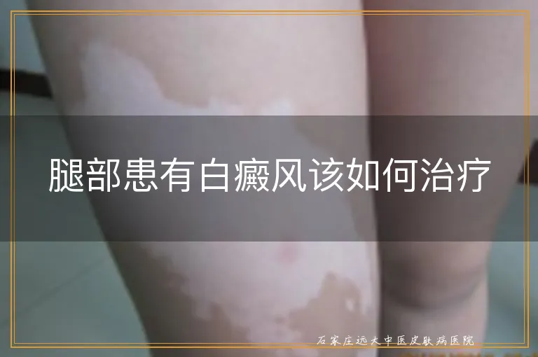 腿部患有白癜风该如何治疗