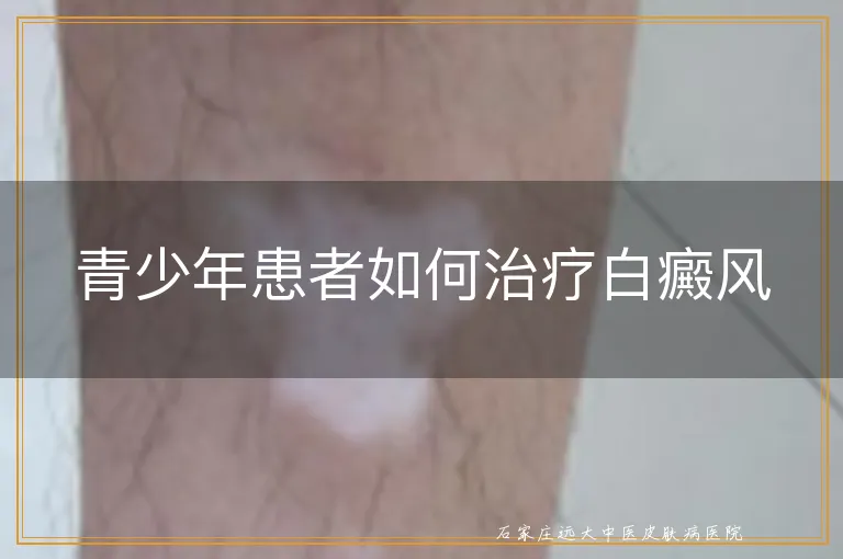 青少年患者如何治疗白癜风