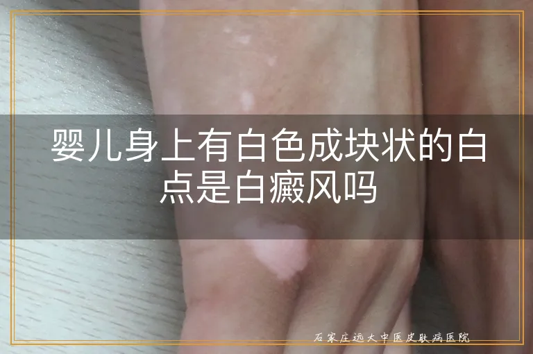 婴儿身上有白色成块状的白点是白癜风吗