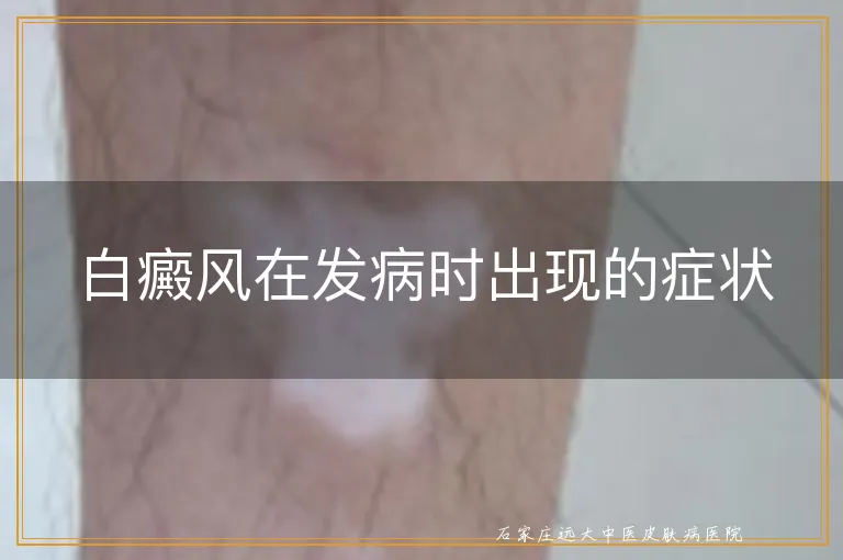 白癜风在发病时出现的症状