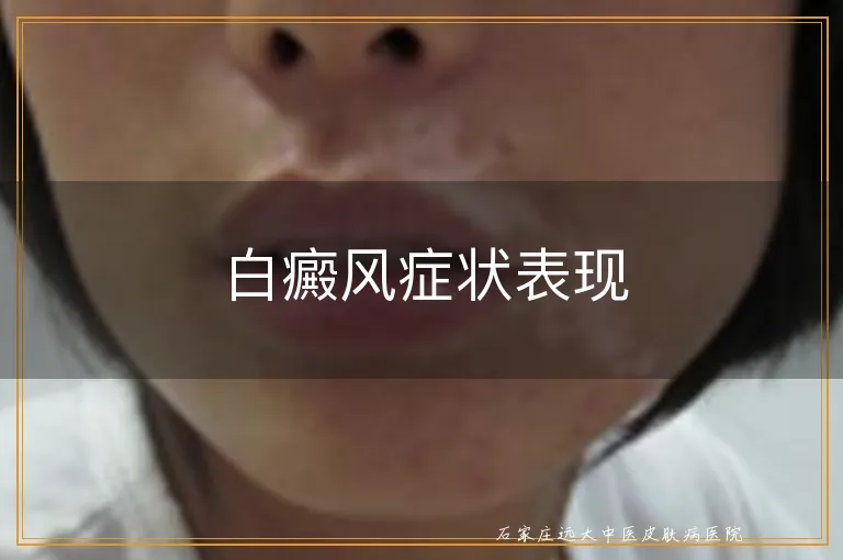 白癜风症状表现