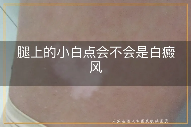 腿上的小白点会不会是白癜风