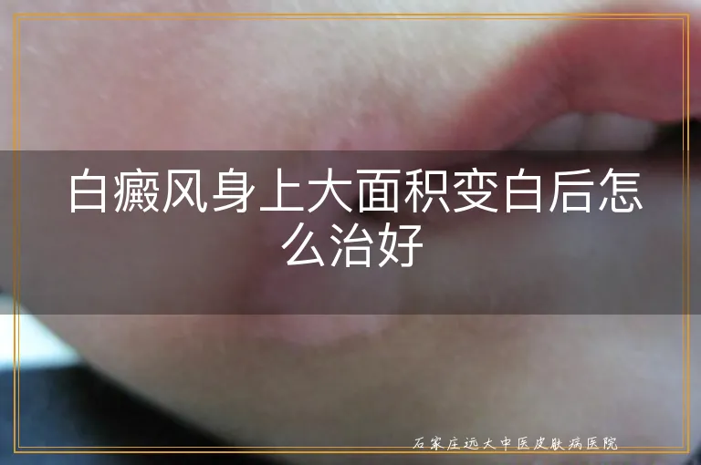 白癜风身上大面积变白后怎么治好