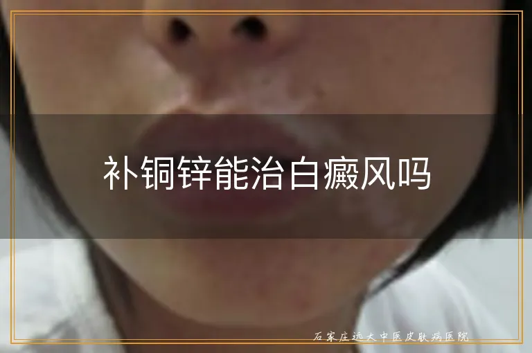 补铜锌能治白癜风吗