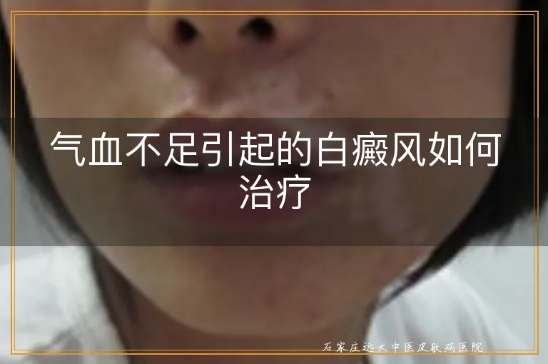 气血不足引起的白癜风如何治疗