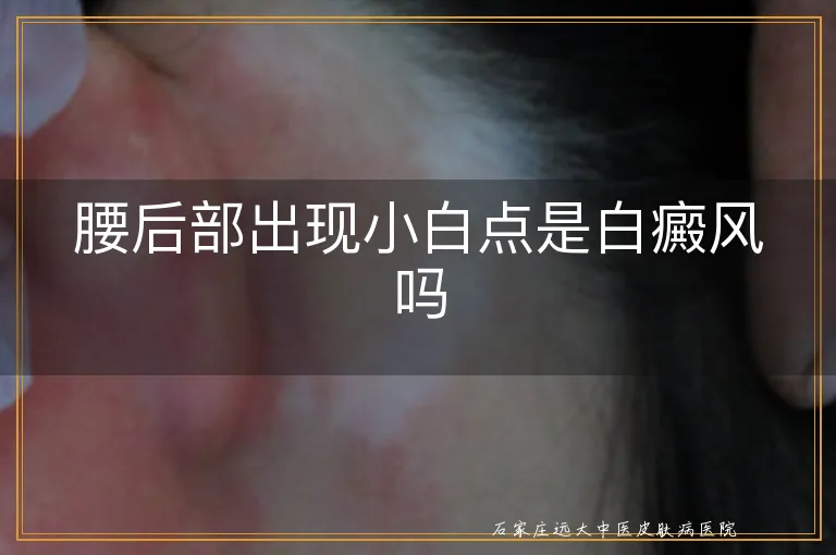 腰后部出现小白点是白癜风吗