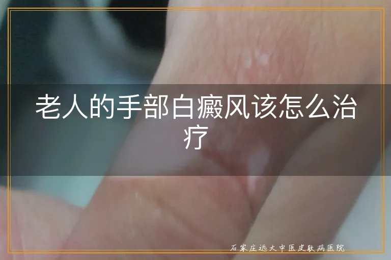 老人的手部白癜风该怎么治疗