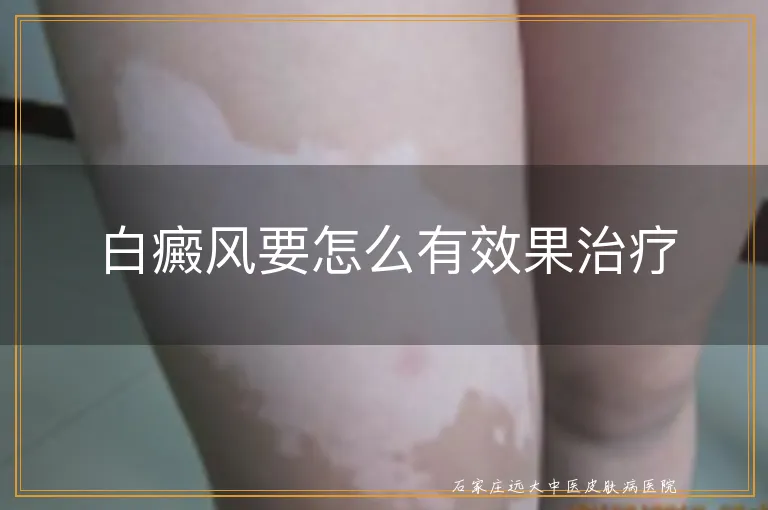 白癜风要怎么有效果治疗