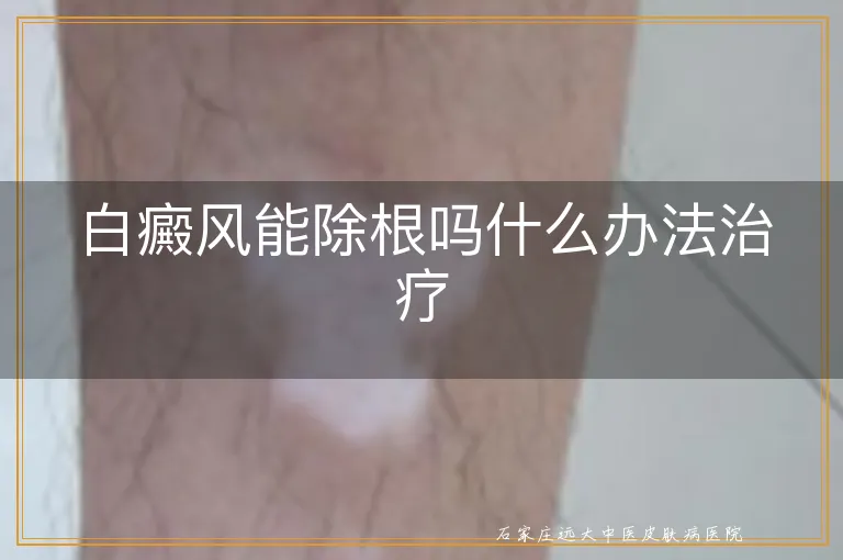 白癜风能除根吗什么办法治疗