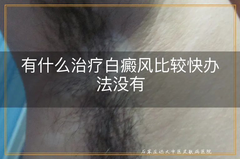 有什么治疗白癜风比较快办法没有