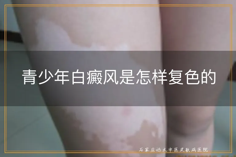 青少年白癜风是怎样复色的