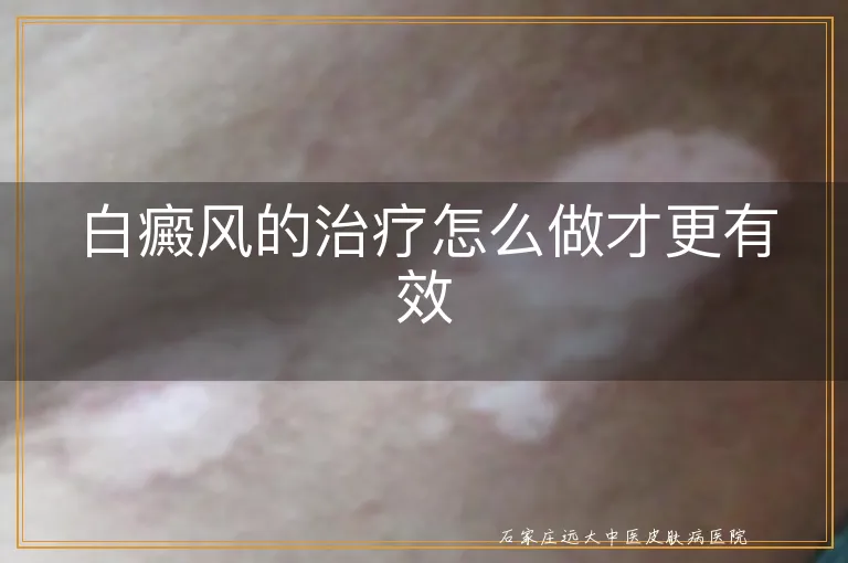 白癜风的治疗怎么做才更有效