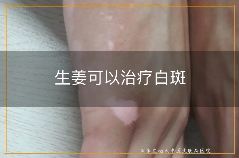 生姜可以治疗白斑