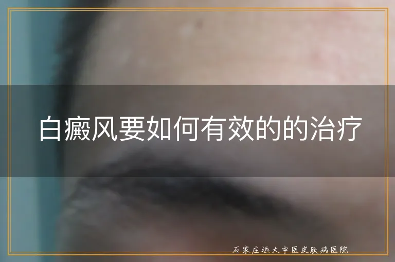 白癜风要如何有效的的治疗