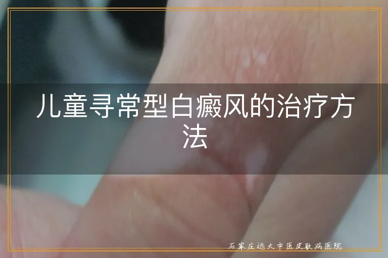 儿童寻常型白癜风的治疗方法