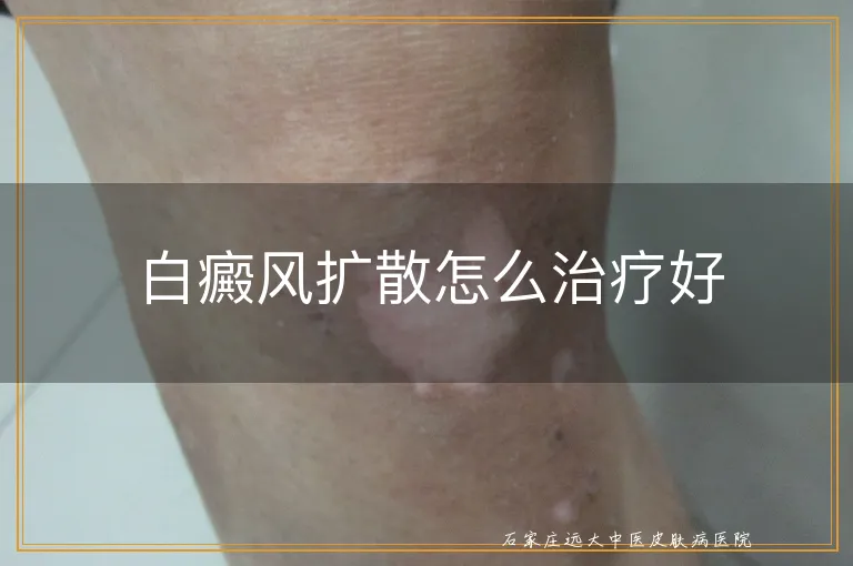 白癜风扩散怎么治疗好