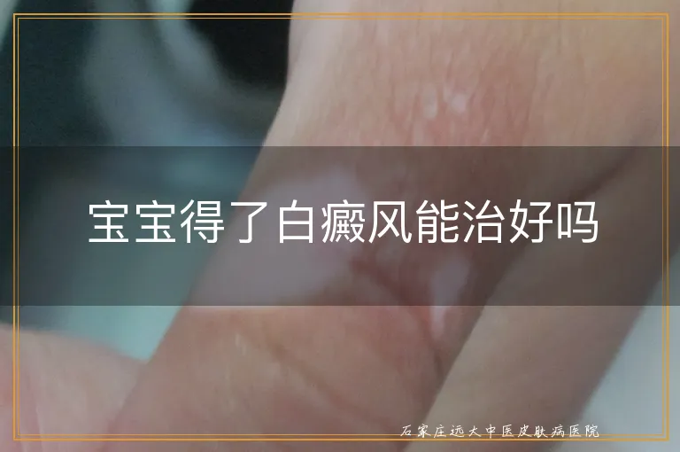 宝宝得了白癜风能治好吗