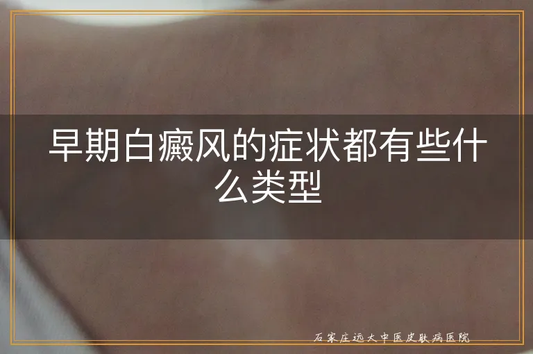 早期白癜风的症状都有些什么类型