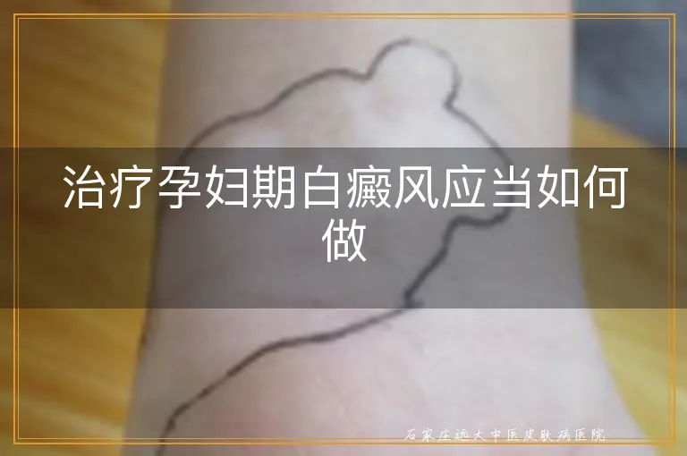 治疗孕妇期白癜风应当如何做