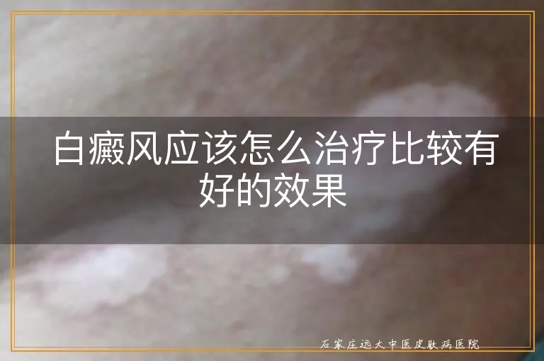 白癜风应该怎么治疗比较有好的效果