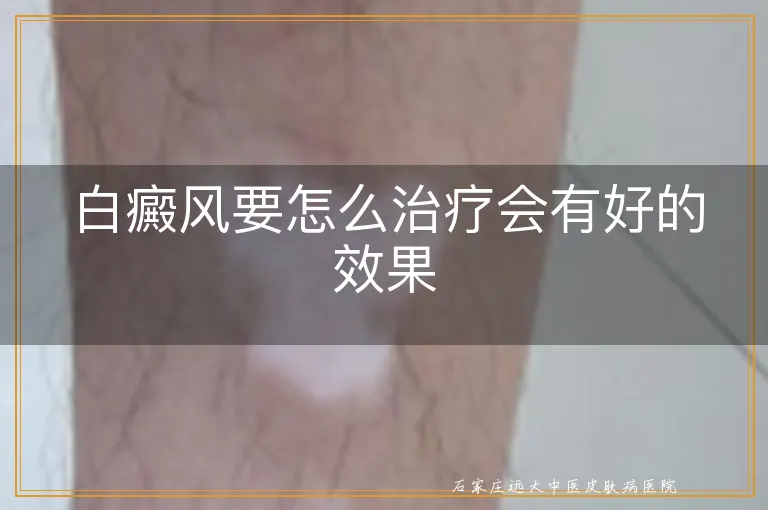 白癜风要怎么治疗会有好的效果